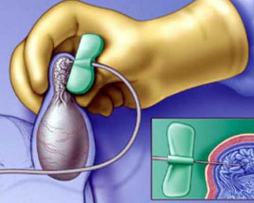 广西供卵包成功 2025广西壮族自治区人民医院试管婴儿费用明细 ‘唐筛数据看男